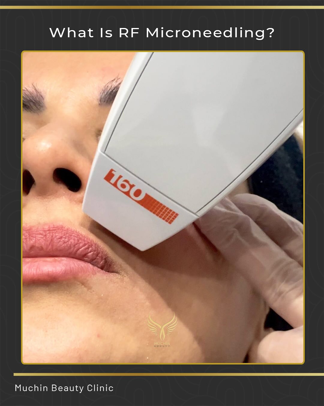 Muchin Beauty — IPL & RF