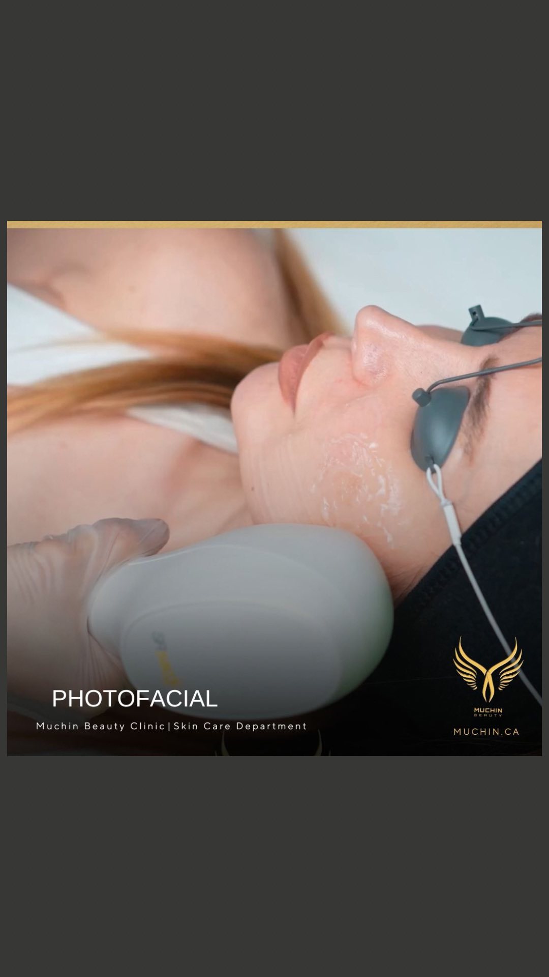 Muchin Beauty — IPL & RF