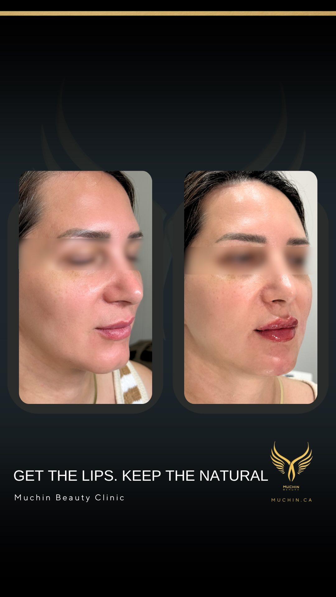 Muchin Beauty — Cosmetic Injection