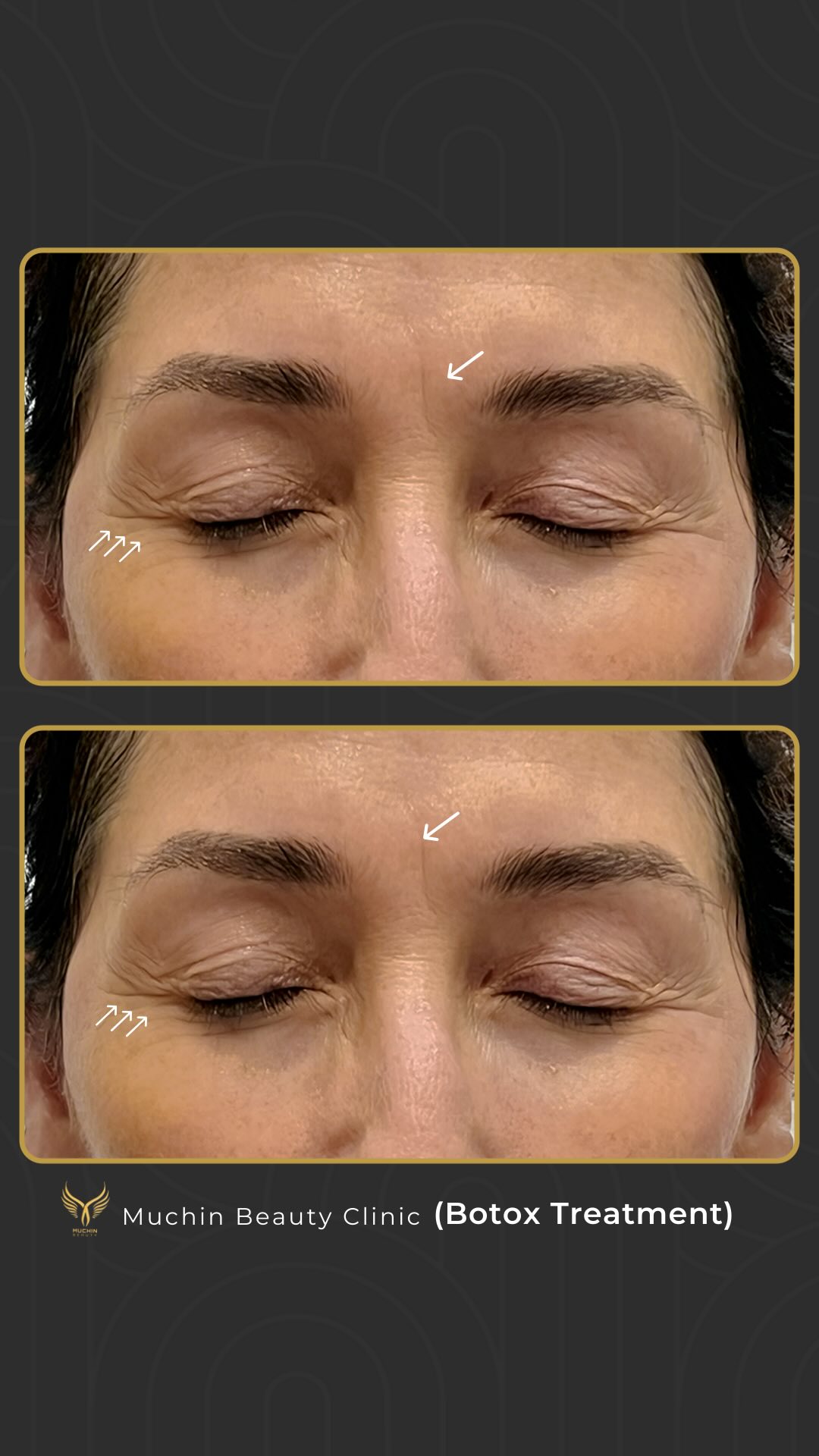 Muchin Beauty — Cosmetic Injection