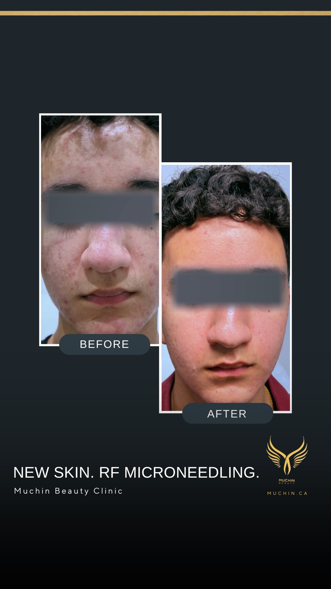 Muchin Beauty — IPL & RF