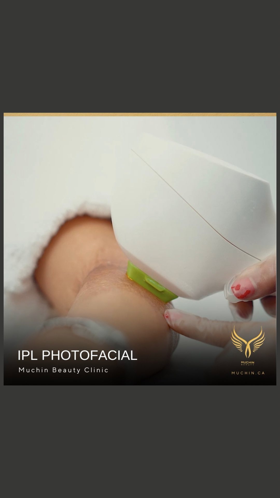 Muchin Beauty — IPL & RF