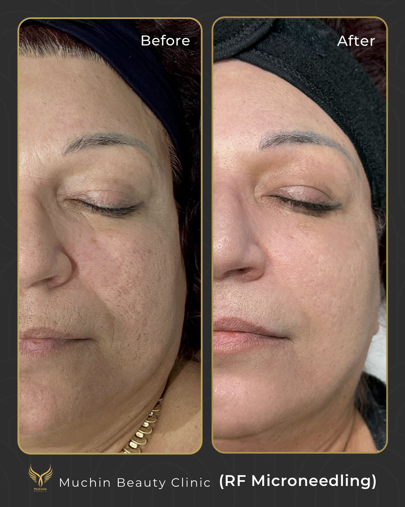 Before & After