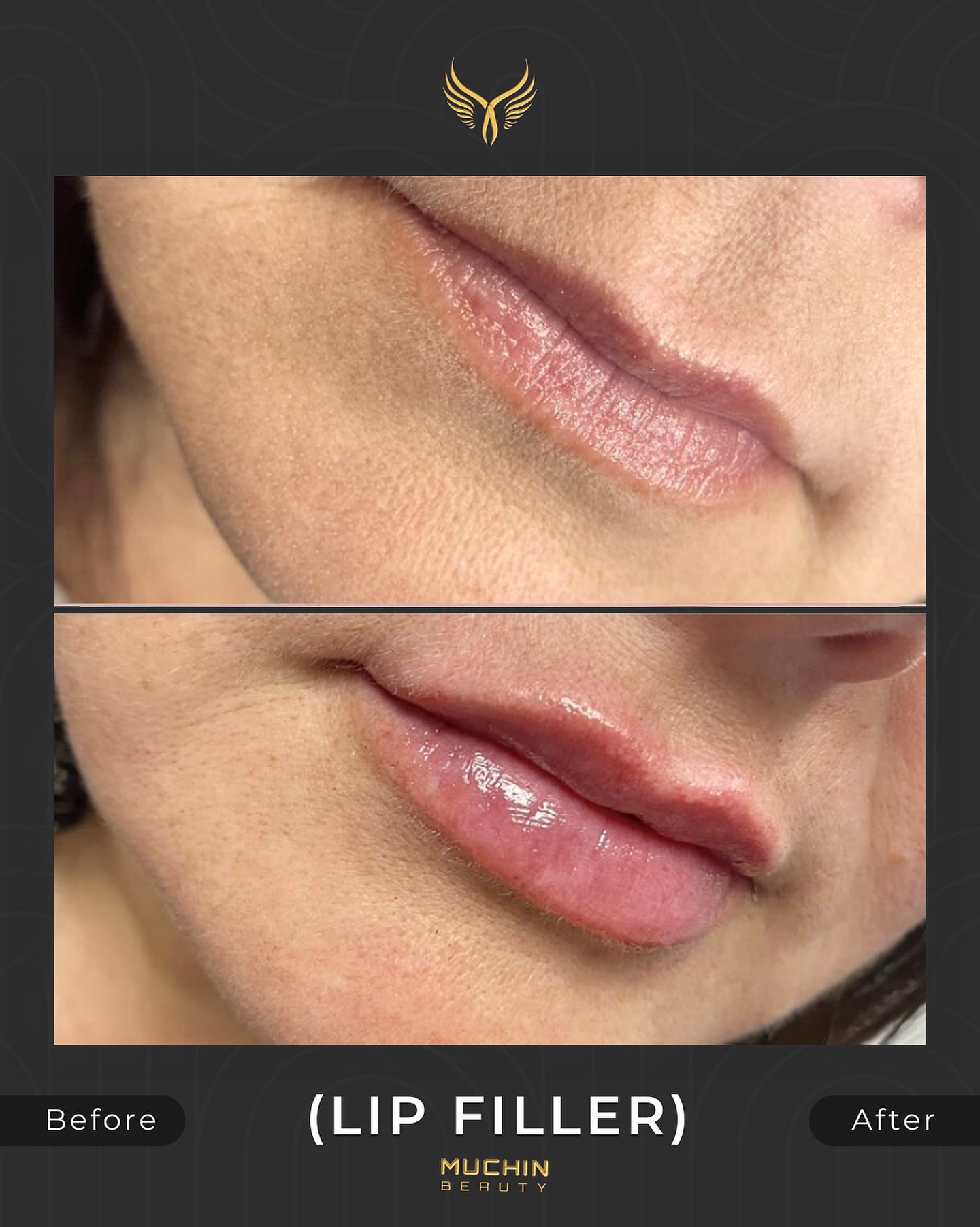Cosmetic Injection result
