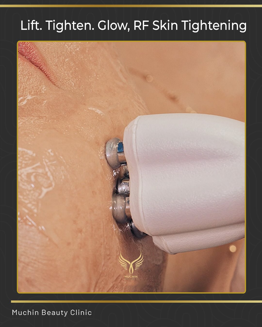 Muchin Beauty — IPL & RF