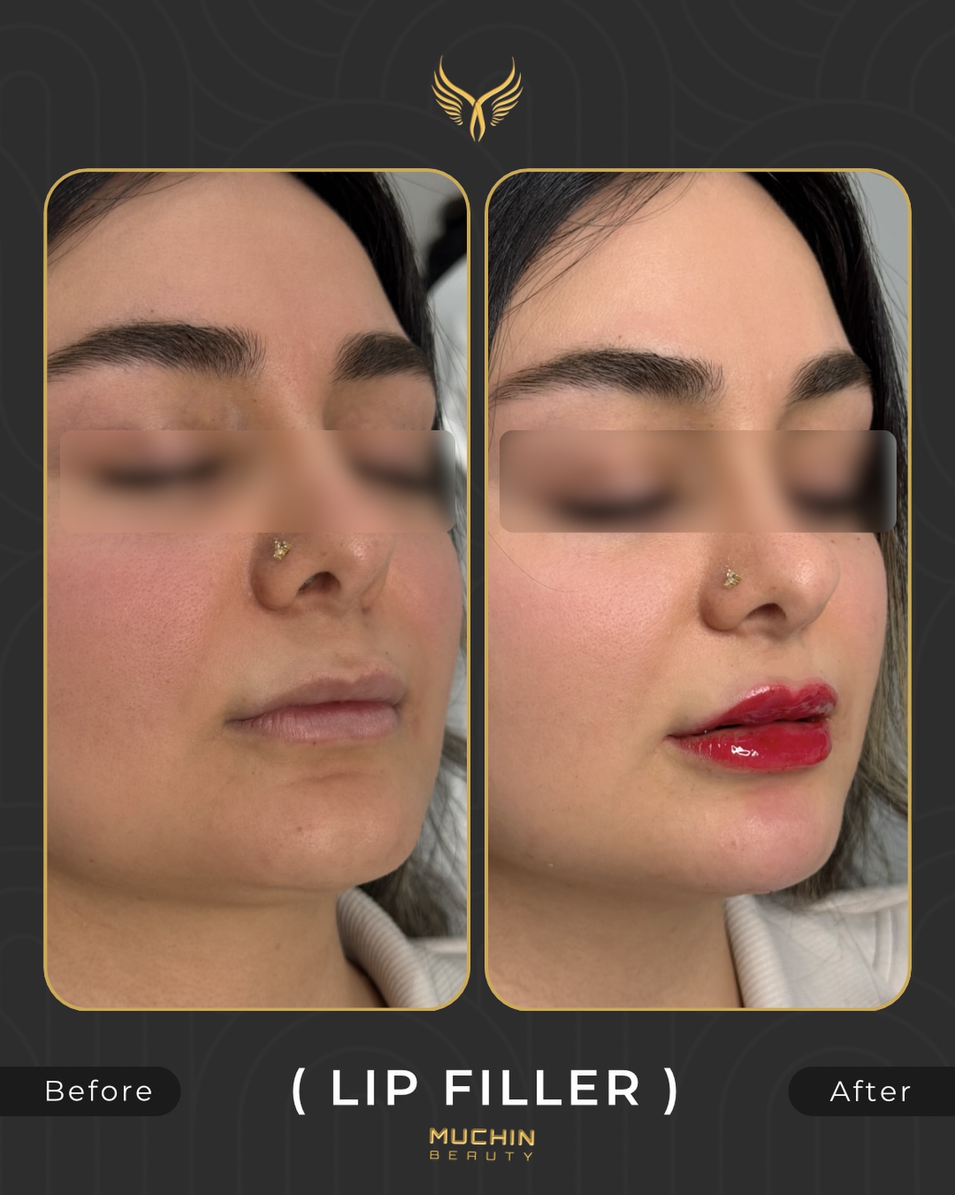 Cosmetic Injection result
