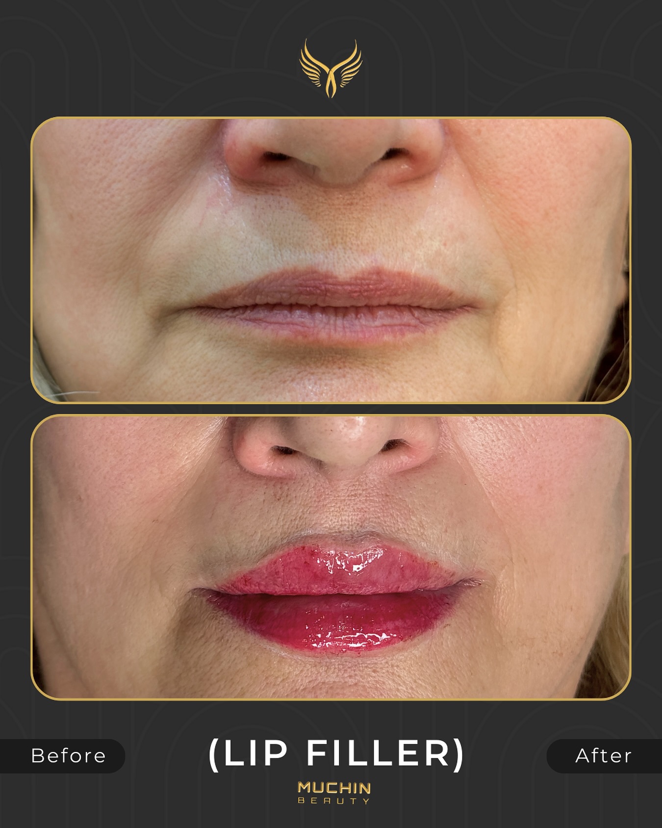 Cosmetic Injection result