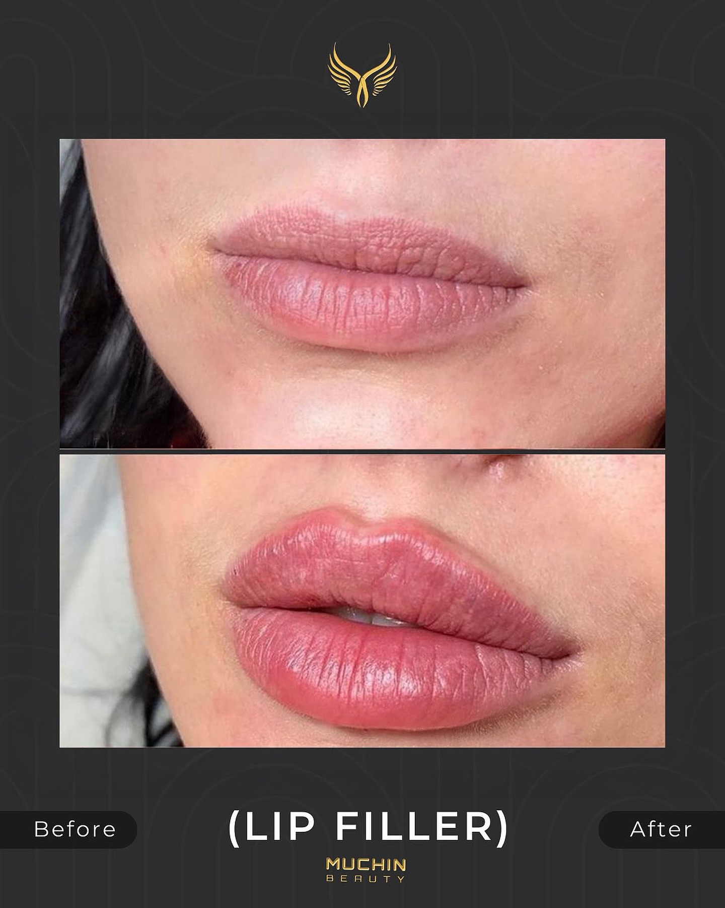 Cosmetic Injection result