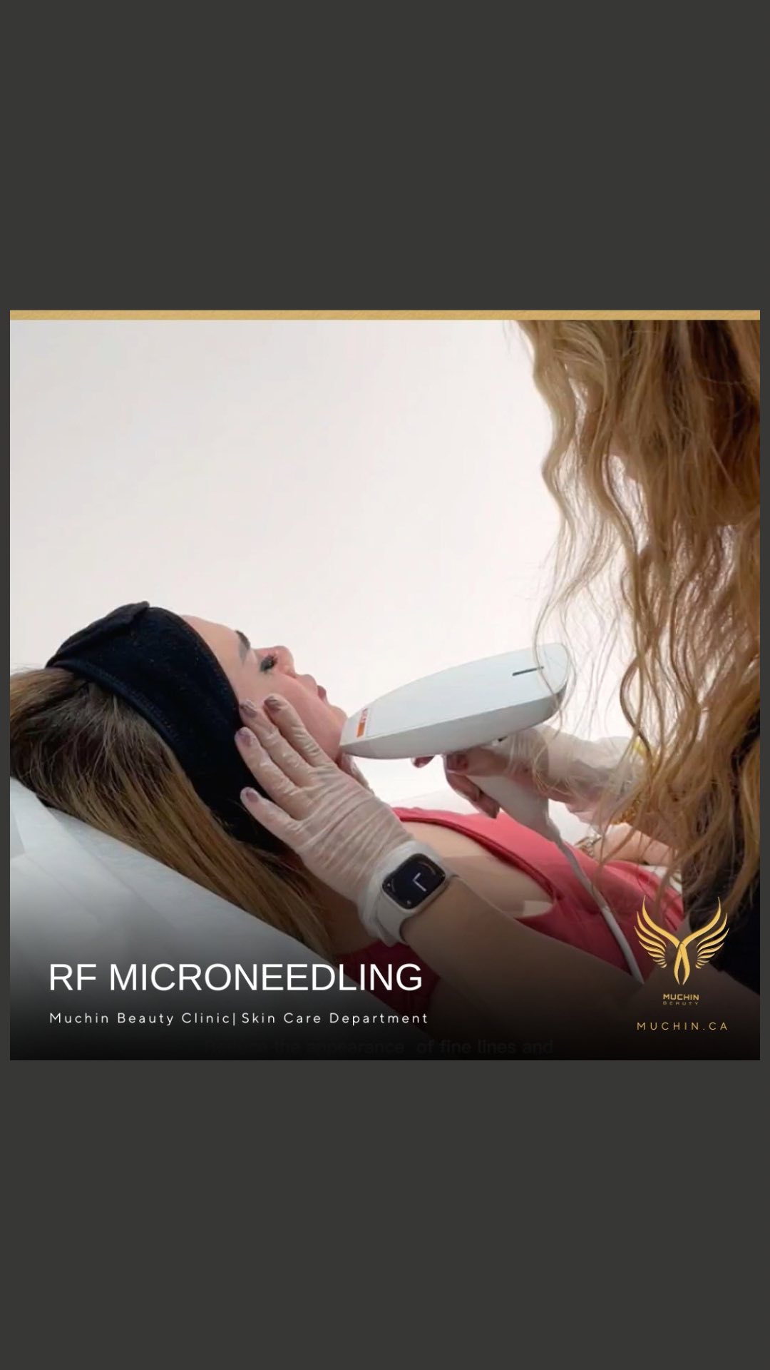 Muchin Beauty — IPL & RF