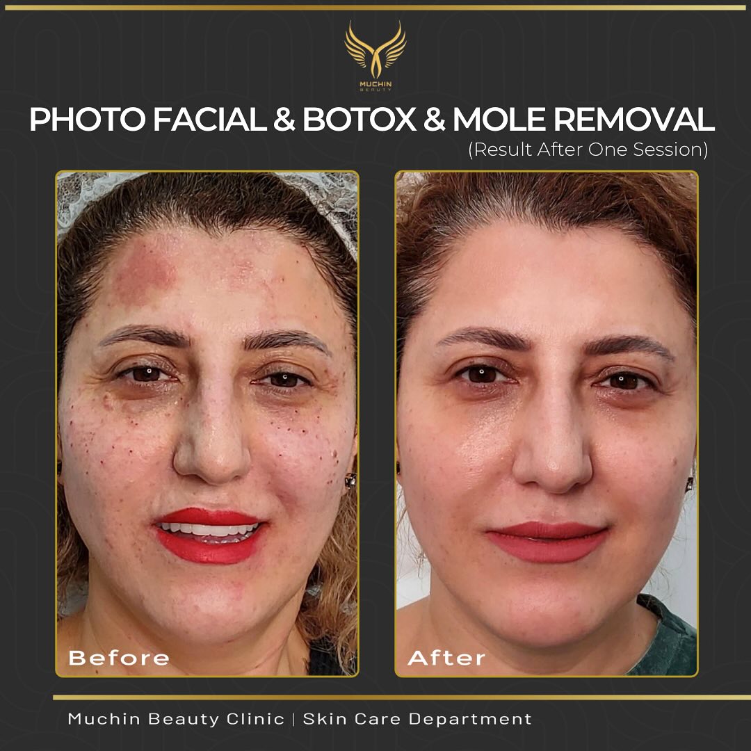 Before and after result