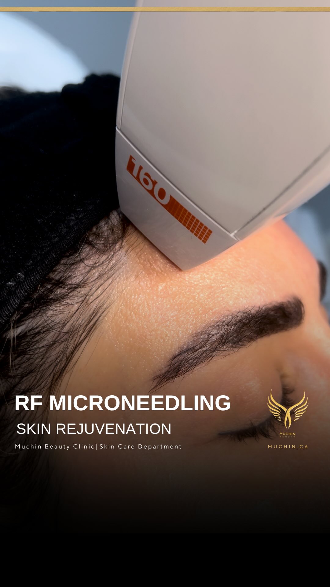 Muchin Beauty — IPL & RF