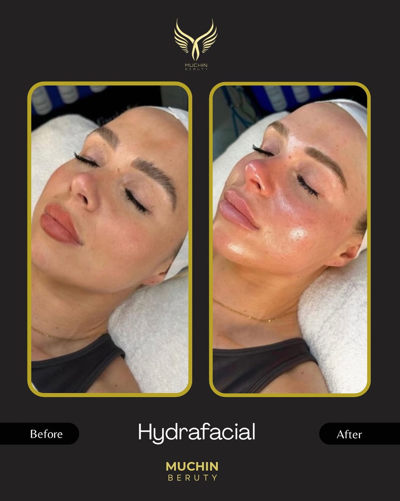 Hydrafacial result