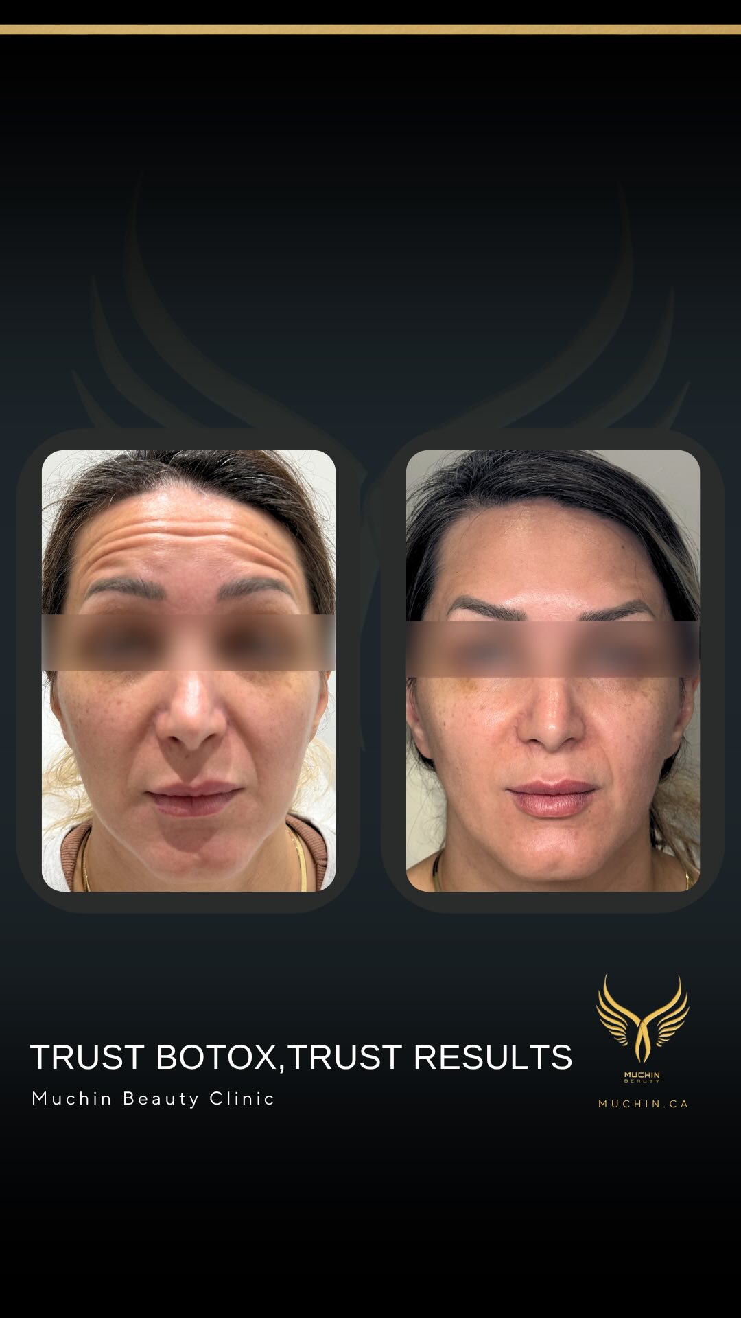 Muchin Beauty — Cosmetic Injection