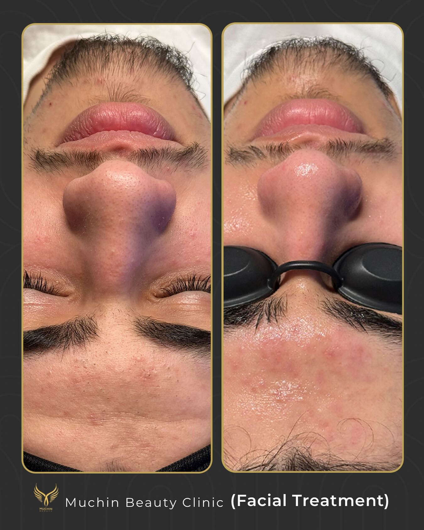 Before and after result