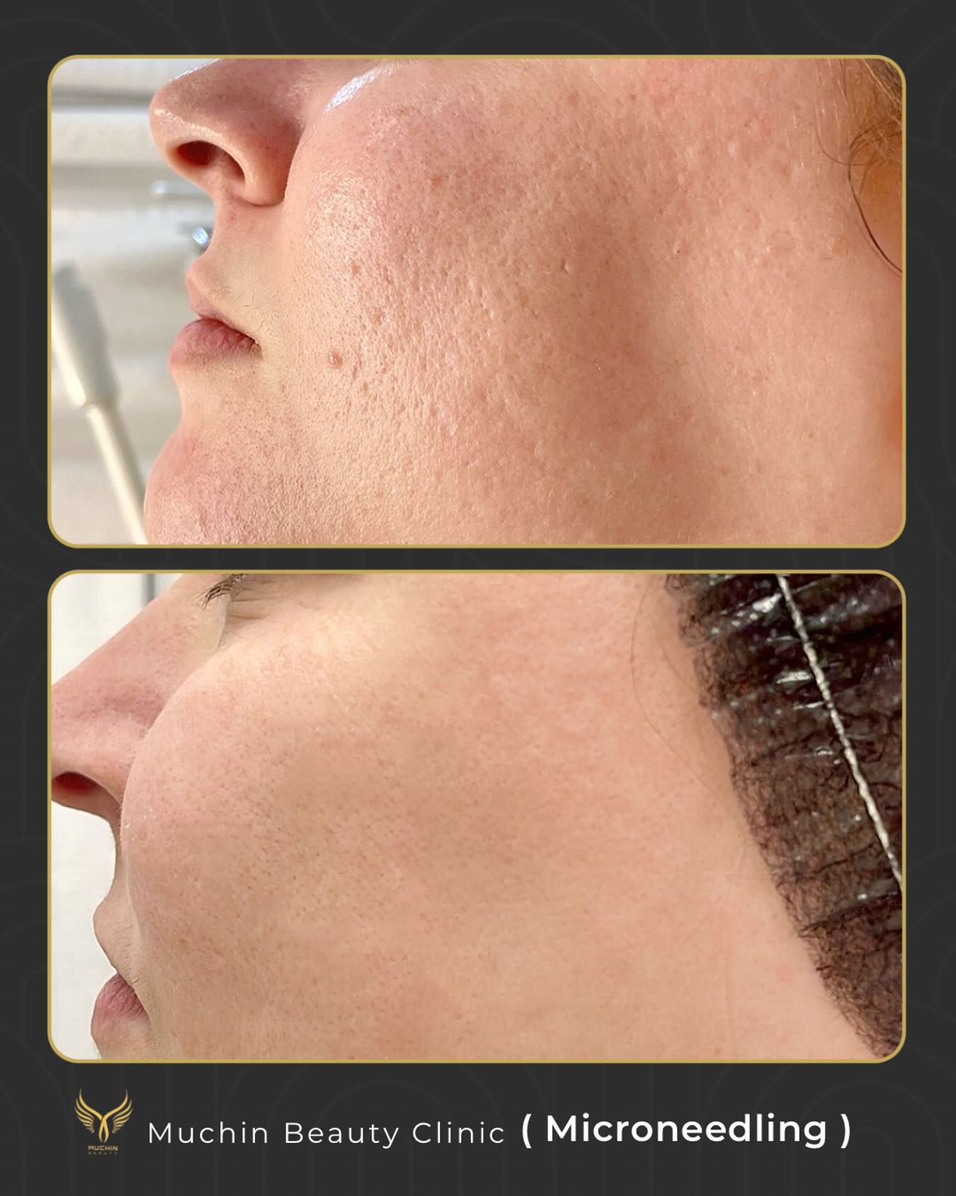 Before and after result
