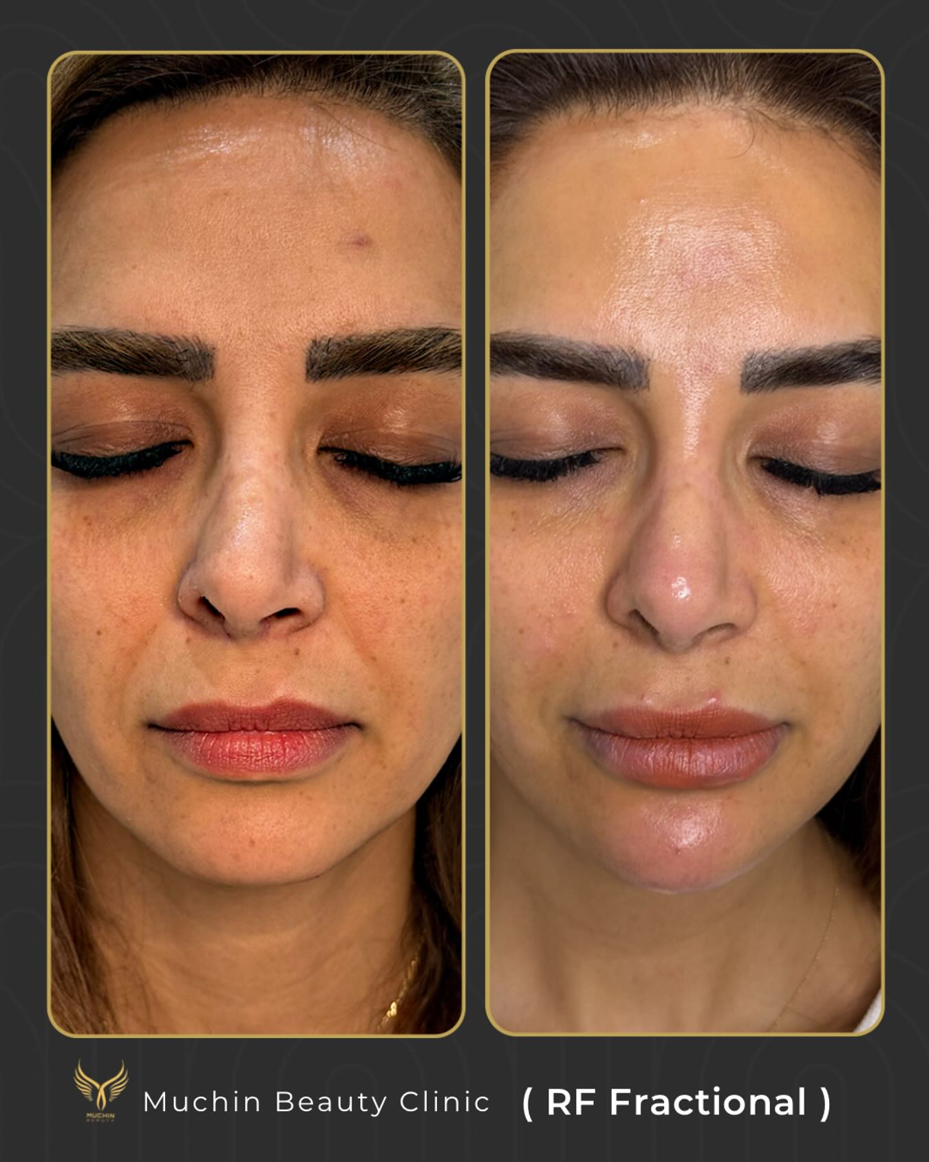 Before and after result