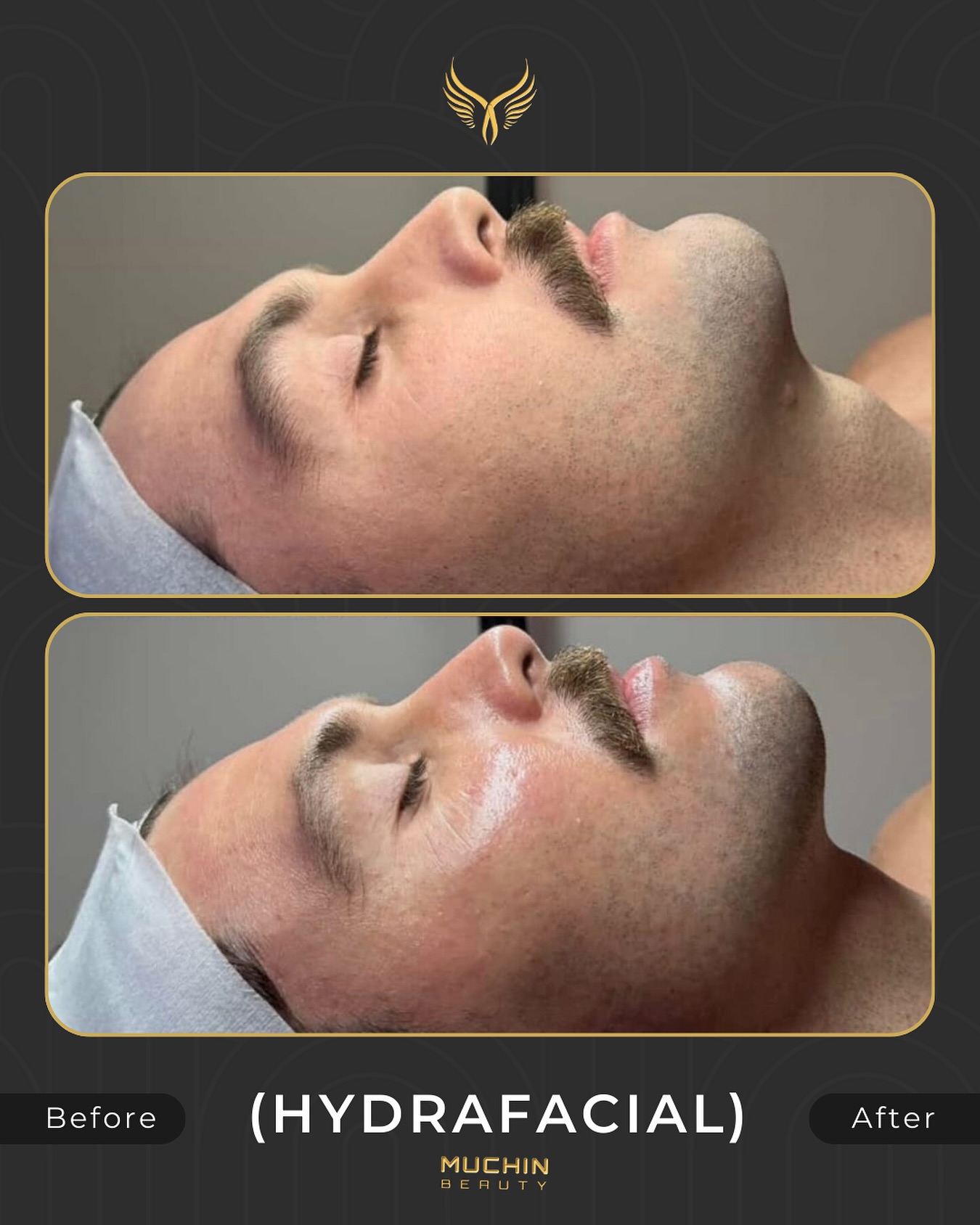Hydrafacial result