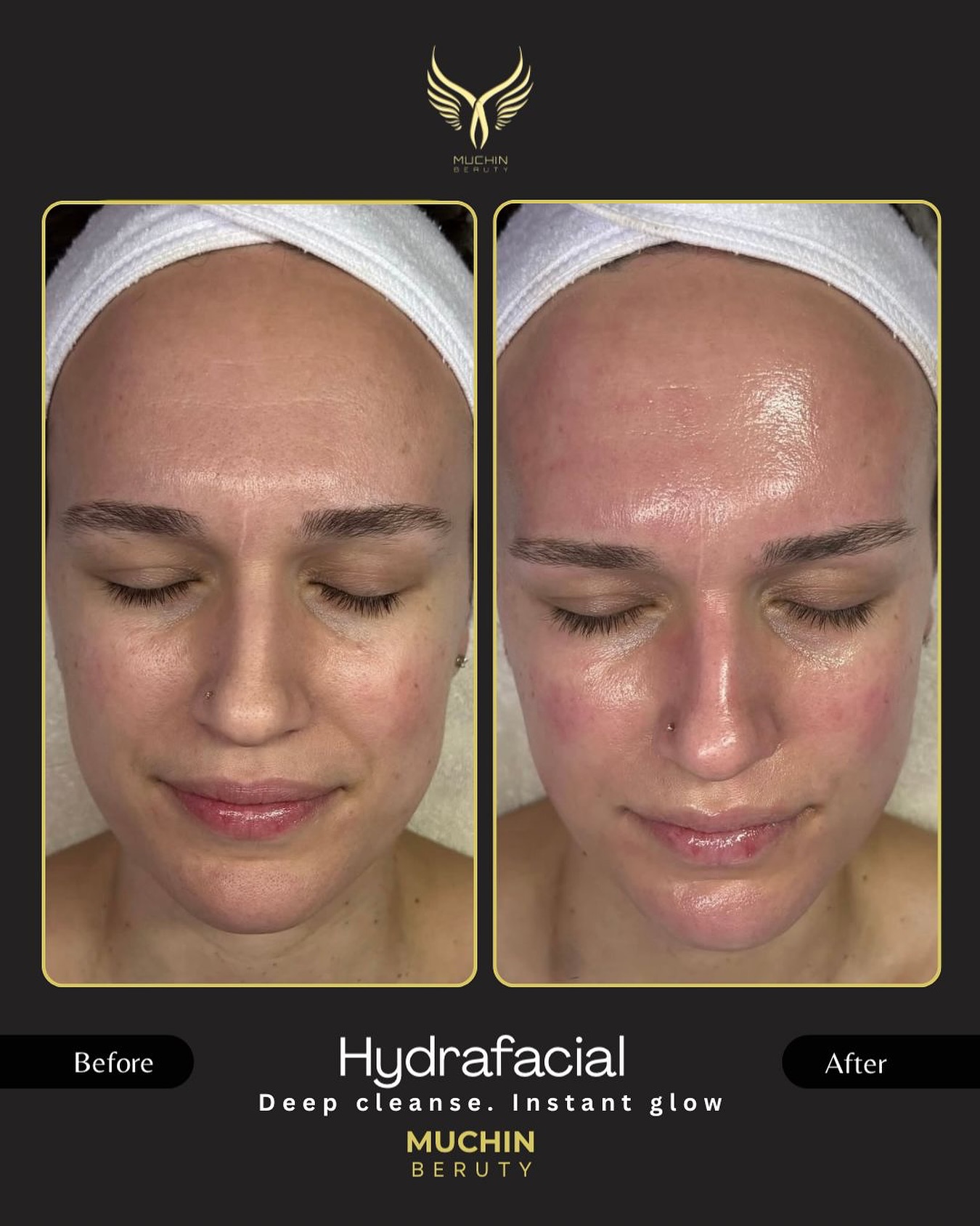 Hydrafacial result