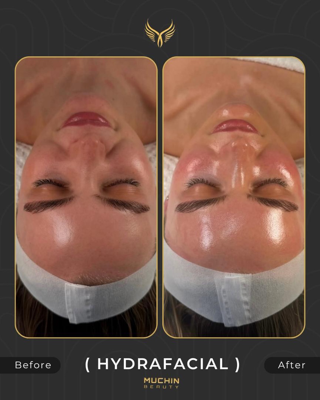 Hydrafacial result