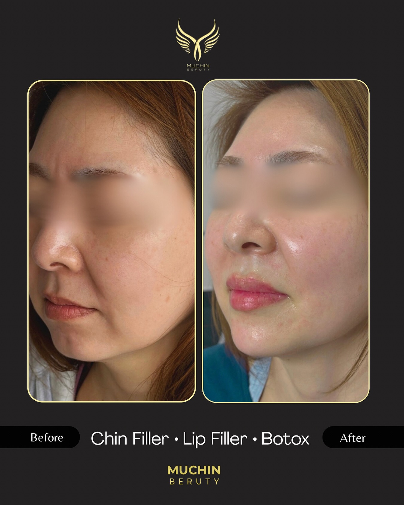 Cosmetic Injection result