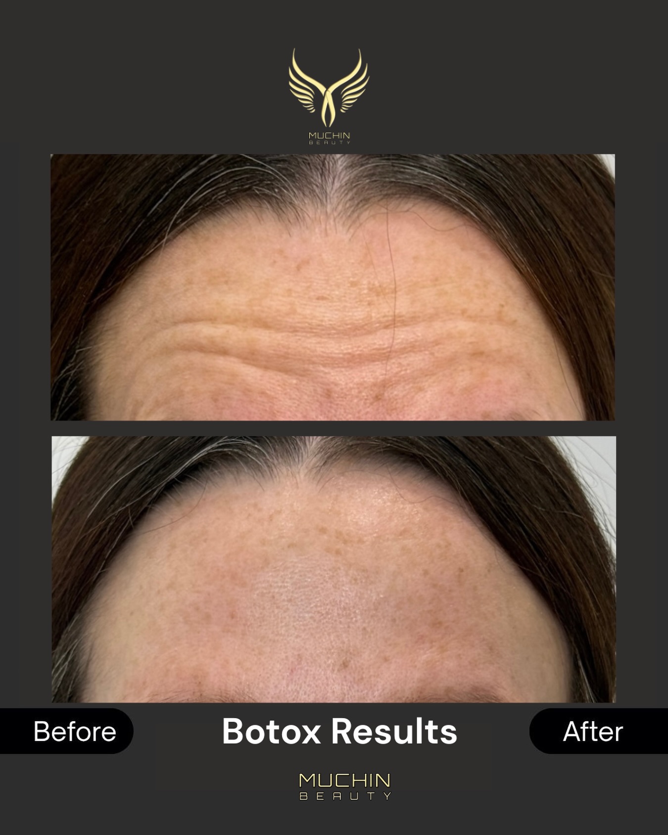 Cosmetic Injection result