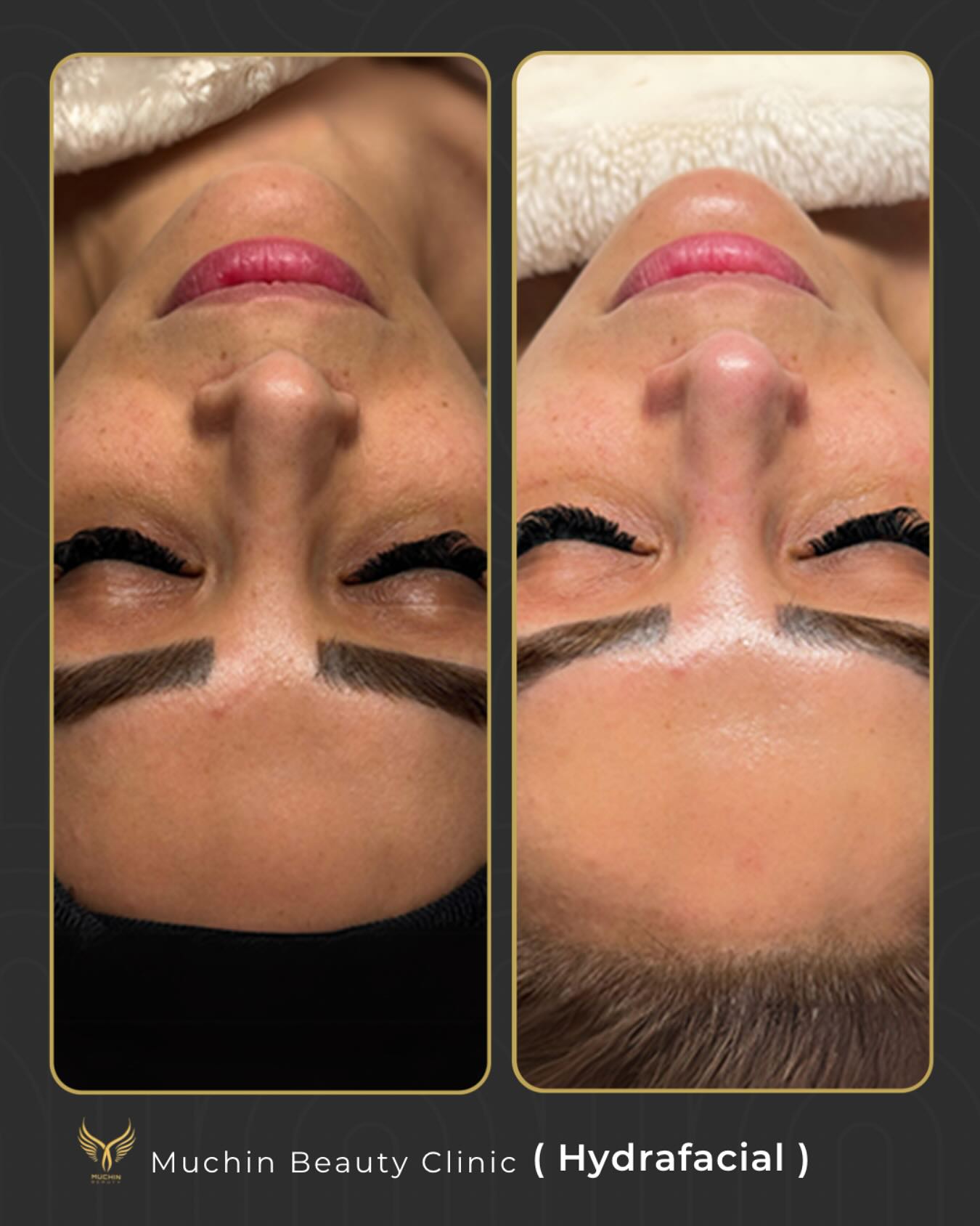 Hydrafacial result