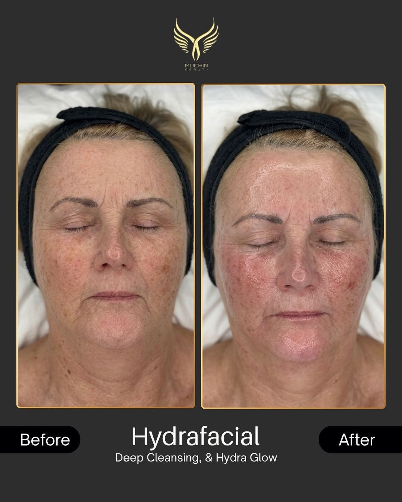 Hydrafacial result