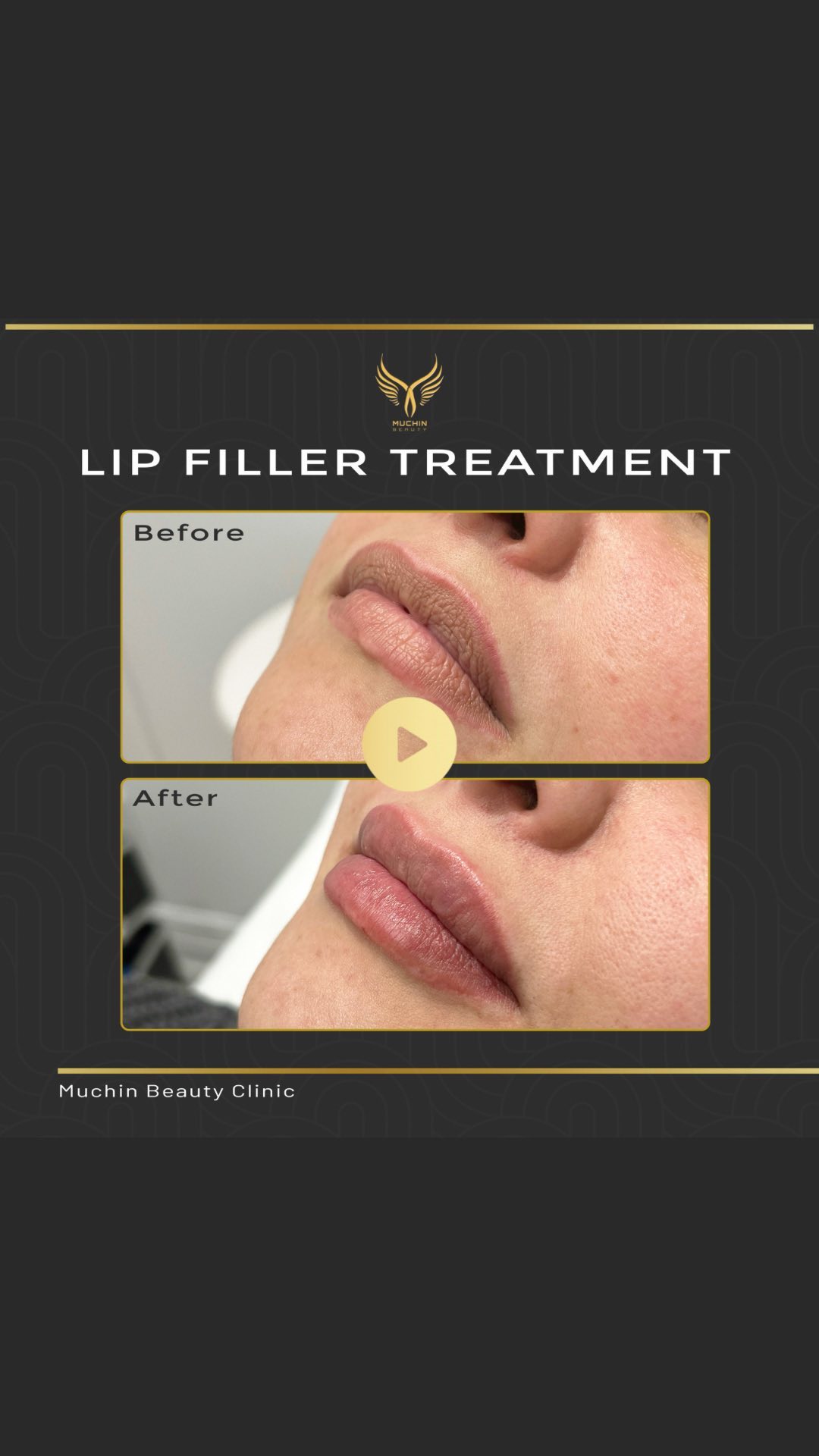 Muchin Beauty — Cosmetic Injection