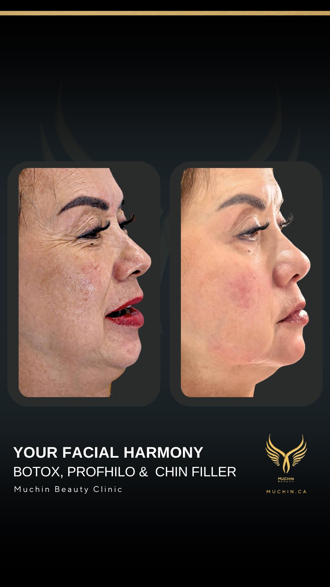 Muchin Beauty — Cosmetic Injection